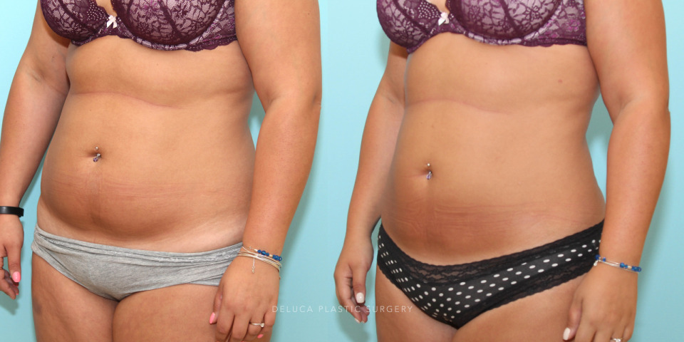 liposuction of the abdomen flanks and back_2.jpg