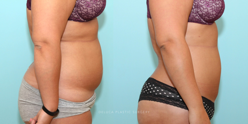 liposuction of the abdomen flanks and back_5.jpg
