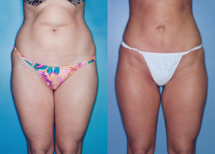 liposuction-albany-before-after-photos-1.jpg