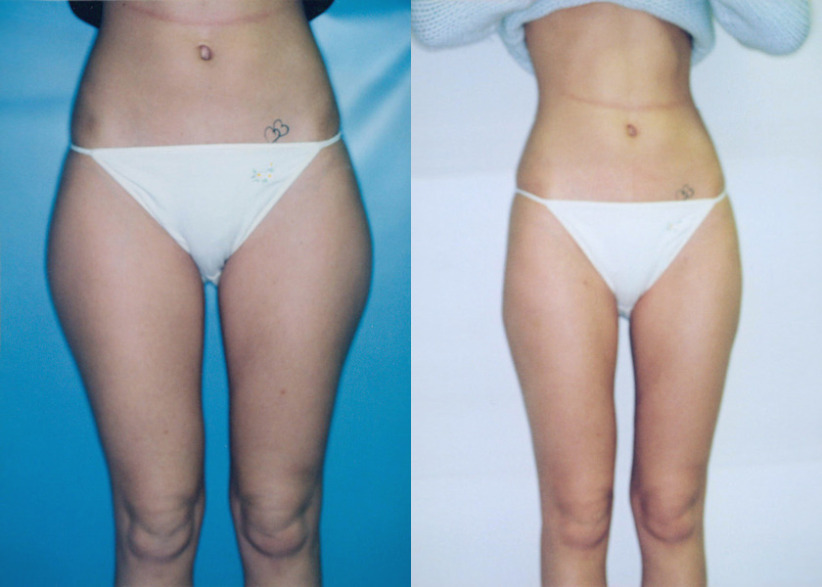 liposuction-before-after-1a-840x600.jpg