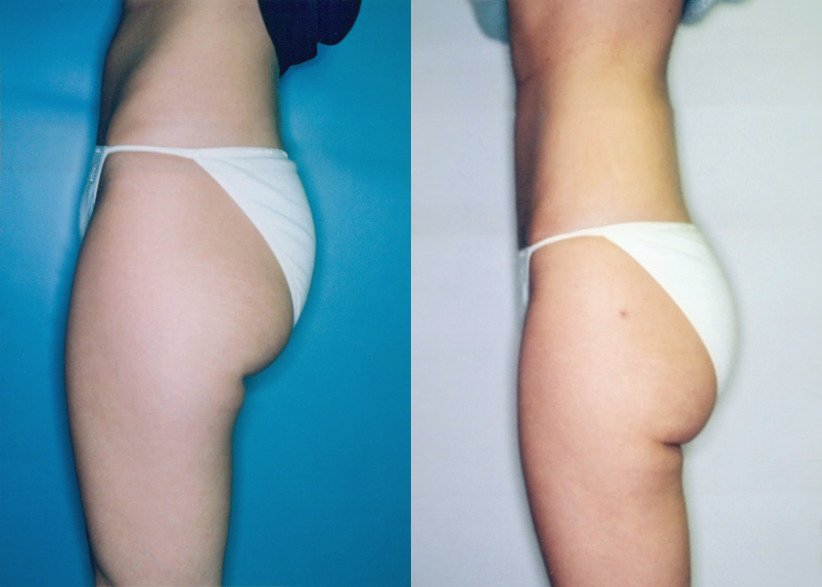 liposuction-before-after-2a-840x600.jpg