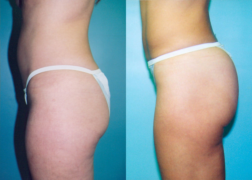 liposuction-before-after-5a-840x600.jpg