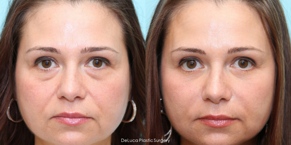 lower-blepharoplasty-puffy-eyes-before-after-1a.jpg