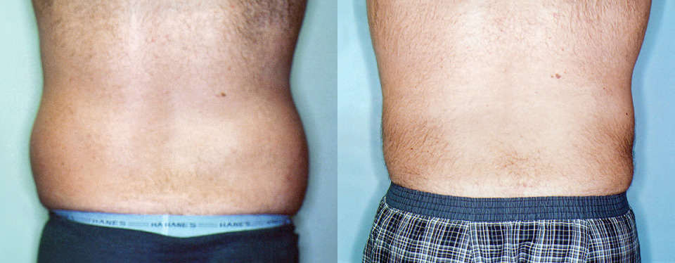 male-liposuction-albany-ny-before-after-photo-2.jpg