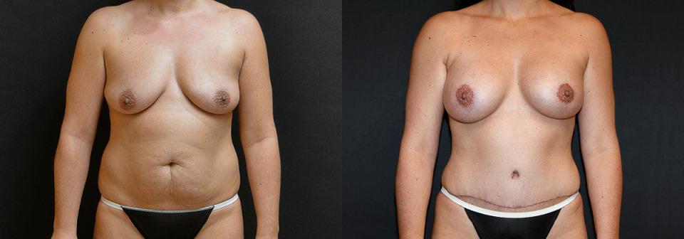 mommy-makeover-albany-breast-tummy-before-after-1c.jpg