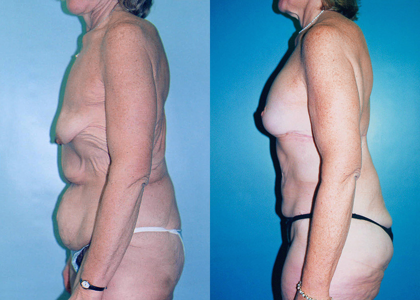 post-bariatric-body-lift-albany-ny-before-after-2.jpg