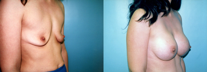 post-pregnancy-breast-augment-beforeafter-3-1200x420.jpg