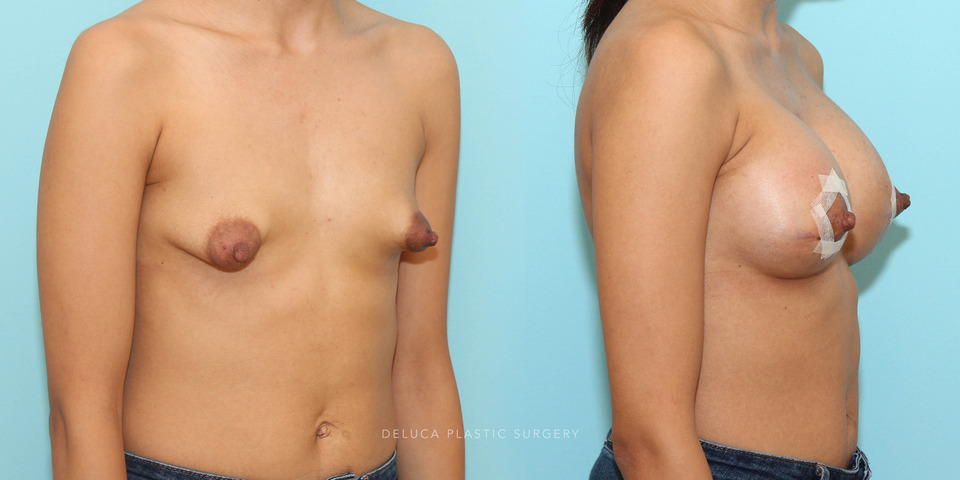 reatment of tuberous breast deformity with 300cc moderate plus smooth silicone implants_4.jpg