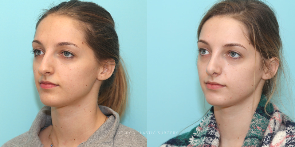 rhinoplasty for convex dorsum and overhanging tip_2.jpg