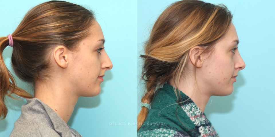 rhinoplasty for convex dorsum and overhanging tip_6.jpg