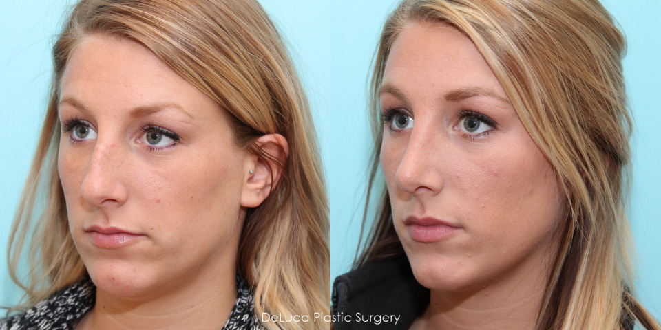 rhinoplasty-before-after-2.jpg
