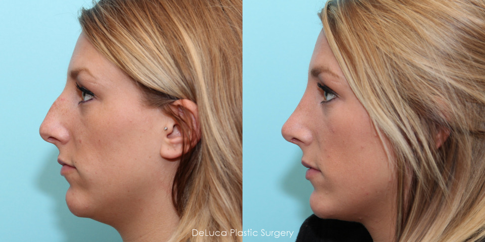 rhinoplasty-before-after-3.jpg