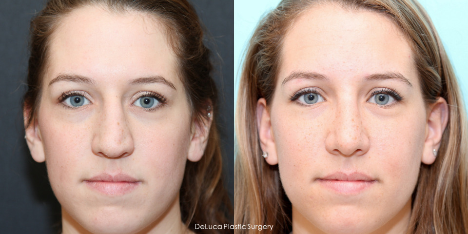 rhinoplasty-hump-reduction-before-after-1.jpg