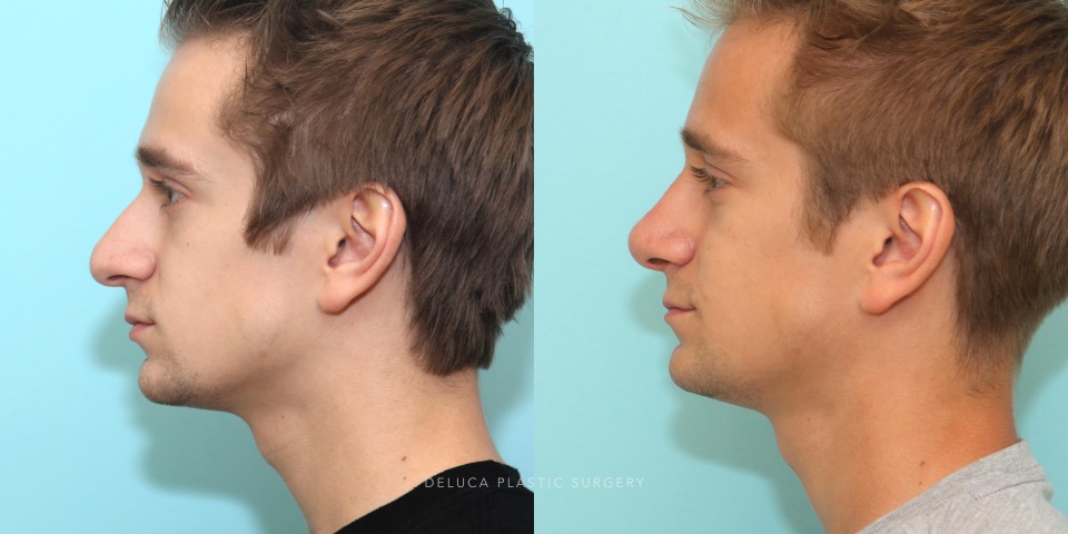 septorhinoplasty for a large deviated nose_1.jpg