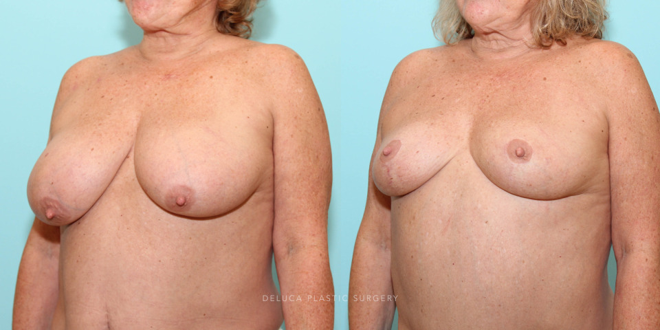 superior medial breast reduction for back and shoulder pain_2.jpg