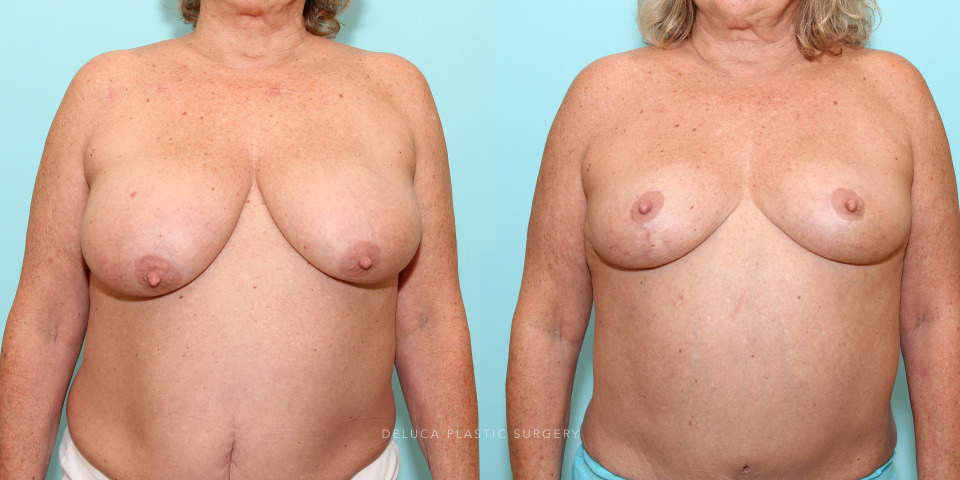 superior medial breast reduction for back and shoulder pain_3.jpg