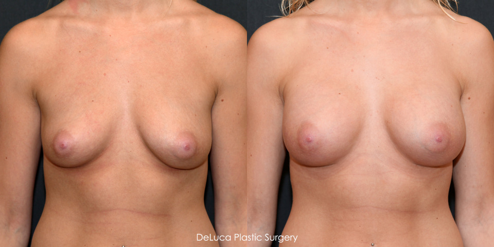 tear-drop-breast-augmentation-before-after-1.jpg