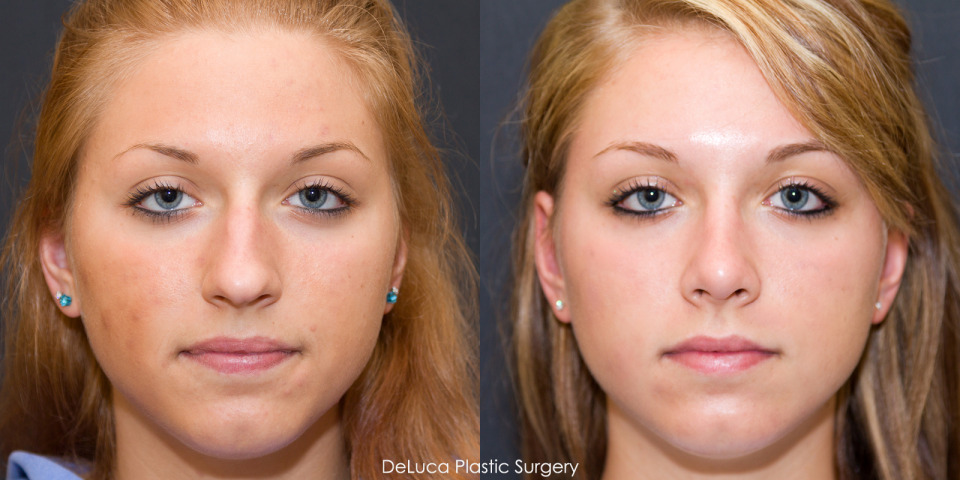 teen-rhinoplasty-new-york-before-after-1.jpg