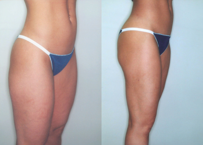 thigh-liposuction-before-after-2-840x600.jpg