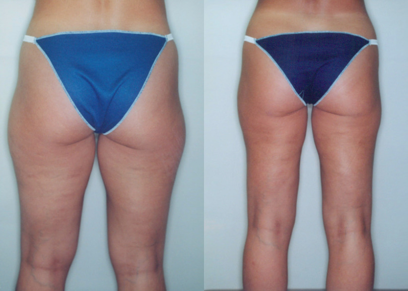 thigh-liposuction-before-after-5-840x600.jpg