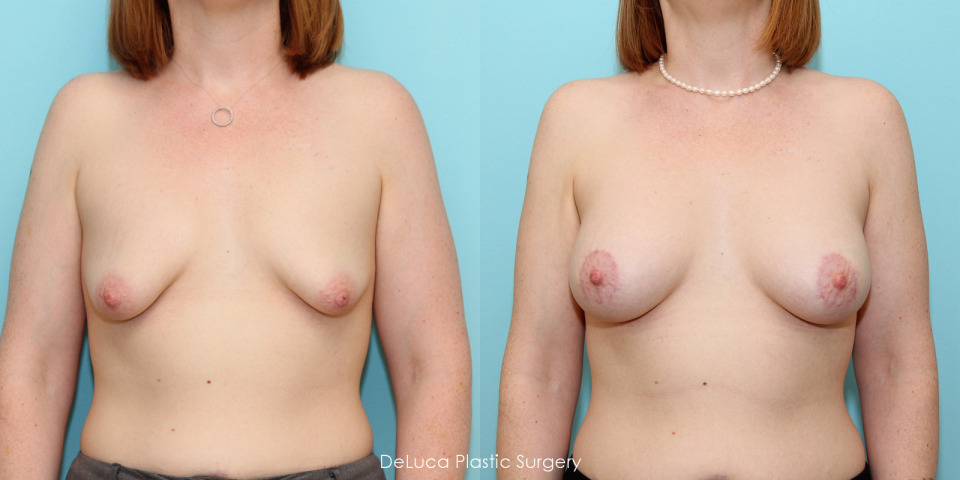 tubular-breast-augmentation-300cc-silicone-before-after-1.jpg