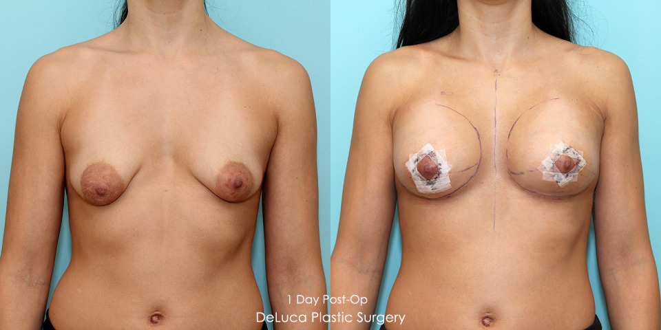 tubular-breast-augmentation-correction-before-after-1.jpg