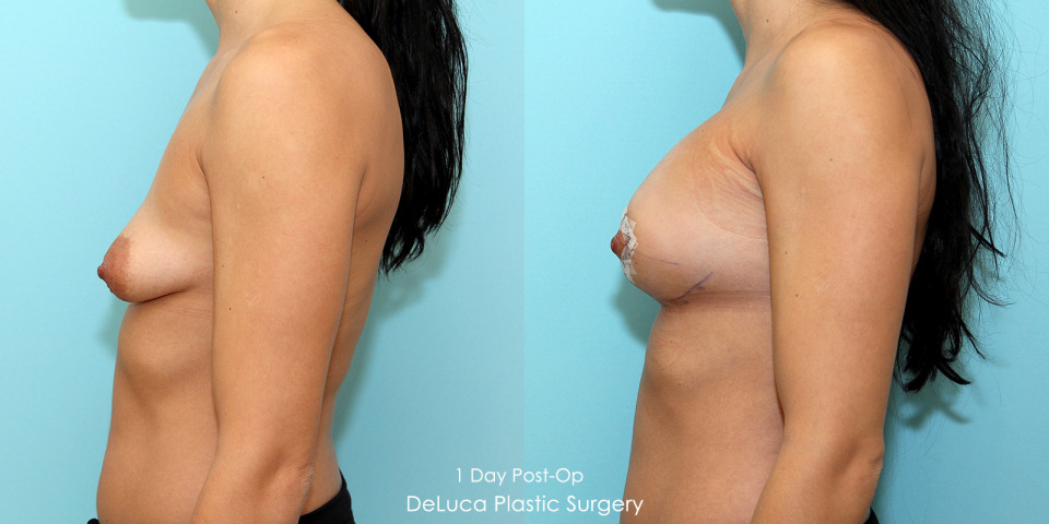 tubular-breast-augmentation-correction-before-after-3.jpg