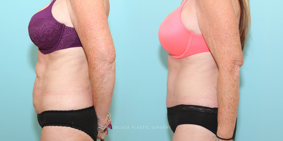 tummy tuck in a 47 year old woman following significant weight loss_1.jpg