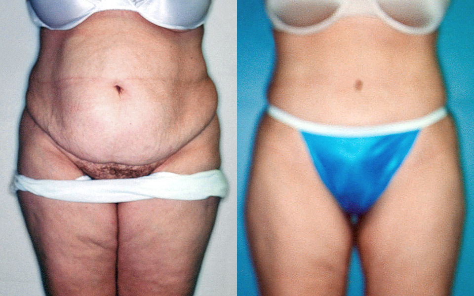tummy-tuck-abdominoplasty-albany-before-after-1.jpg