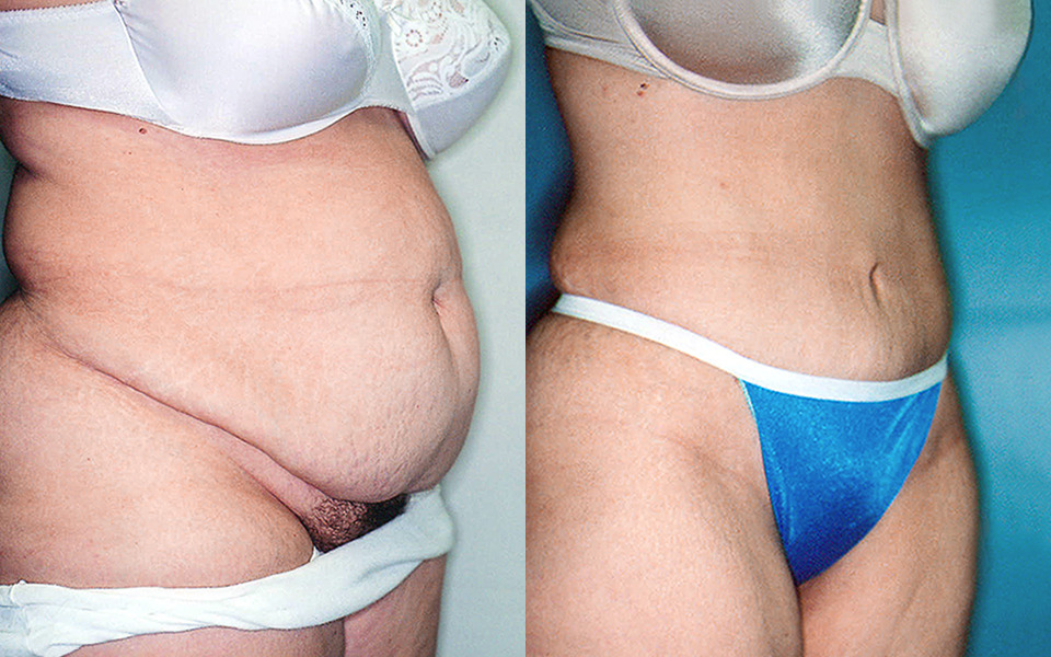 tummy-tuck-abdominoplasty-albany-before-after-2b.jpg