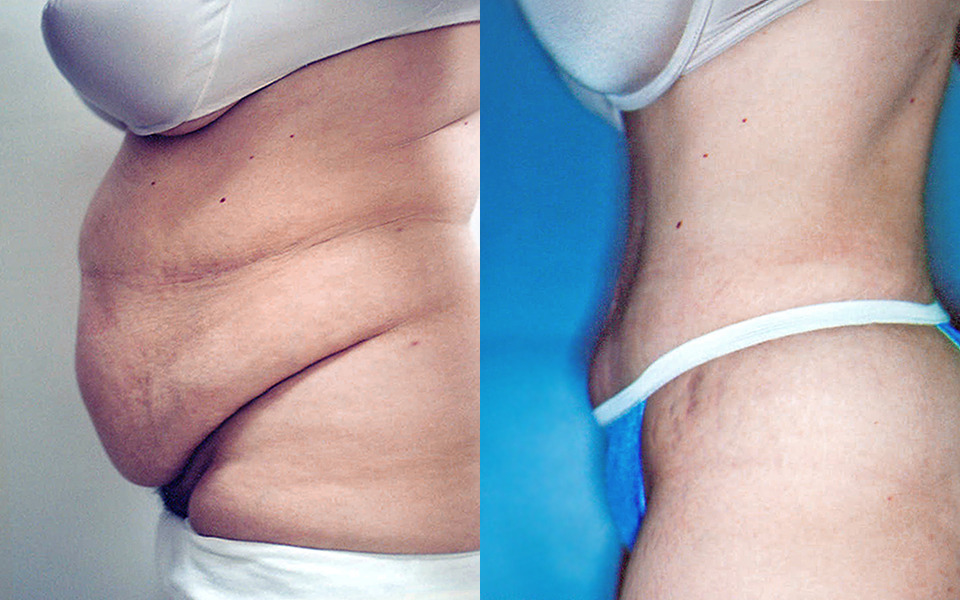 Full Tummy Tuck After C-Section 39-Year-Old Patient Left Profile Photos -  Tummy Tuck Before and After - DeLuca Plastic Surgery