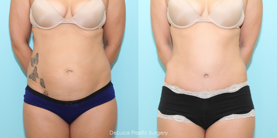 tummy-tuck-before-after-1.jpg