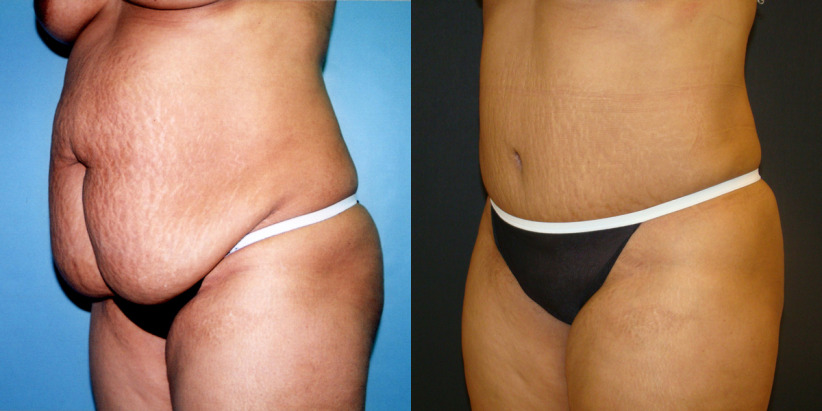 tummy-tuck-before-after-2-1200x600.jpg