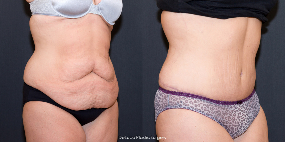 tummy-tuck-before-after-2.jpg
