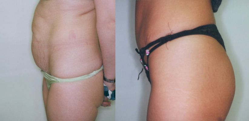 tummy-tuck-before-after-3-1230x600.jpg