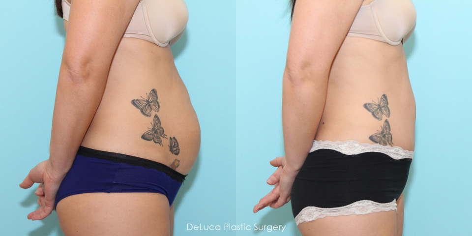 tummy-tuck-before-after-5.jpg