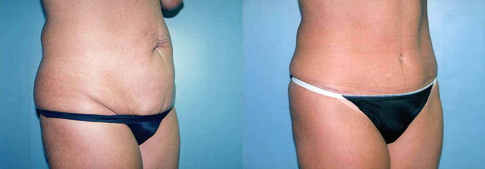 tummy-tuck-breast-lift-augment-before-after-2a-1200x420.jpg