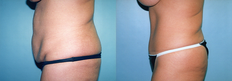 tummy-tuck-breast-lift-augment-before-after-4a-1200x420.jpg