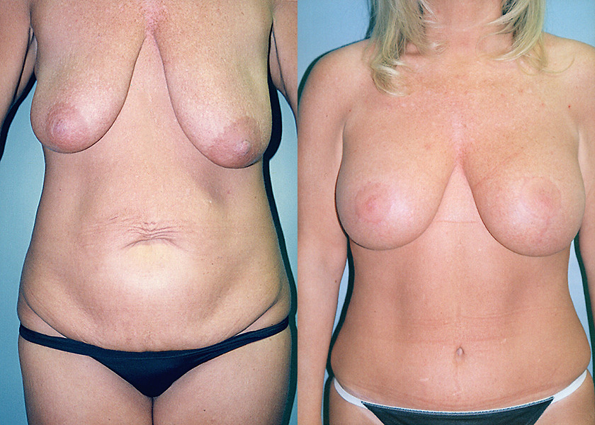 tummy-tuck-breast-lift-augment-before-after-6-1200x420.jpg