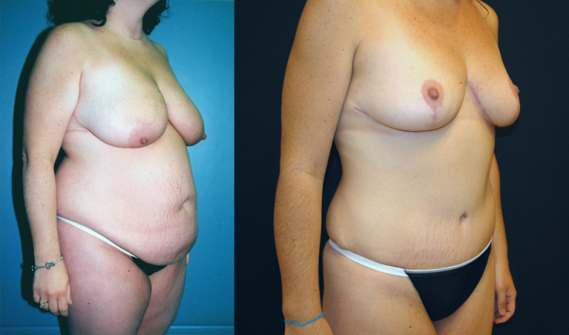 tummy-tuck-breast-lift-before-after-3b-1020x600.jpg