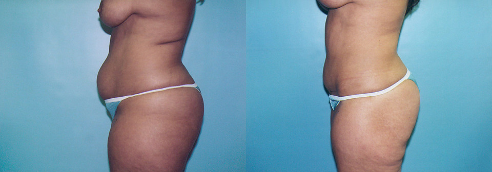 tummy-tuck-breast-reduction-lipo-before-after-8-1200x420.jpg