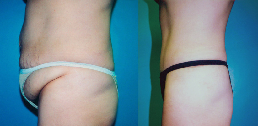 tummy-tuck-fupa-before-after-5-1230x600.jpg