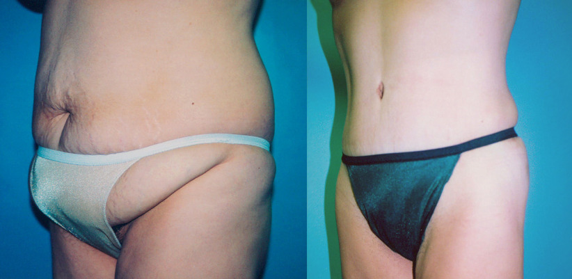 tummy-tuck-fupa-before-after2-1230x600.jpg