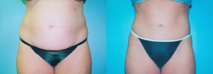 tummy-tuck-liposuction-before-after-1-1200x420.jpg