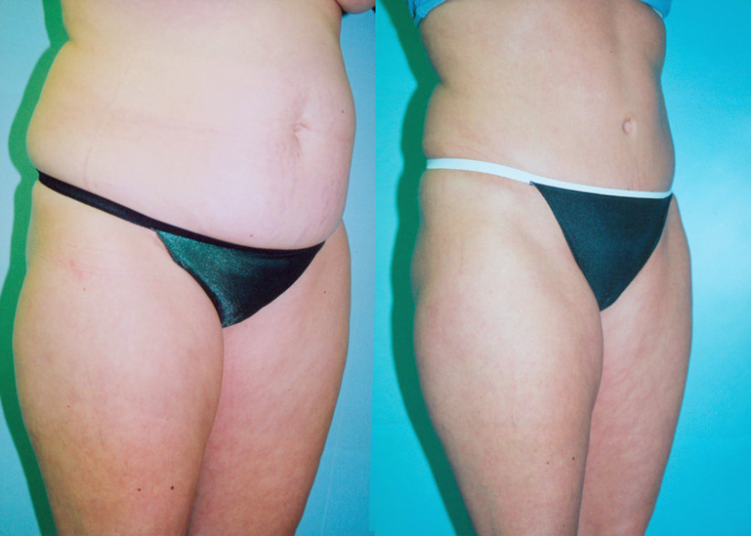 tummy-tuck-liposuction-before-after-2a-840x600.jpg