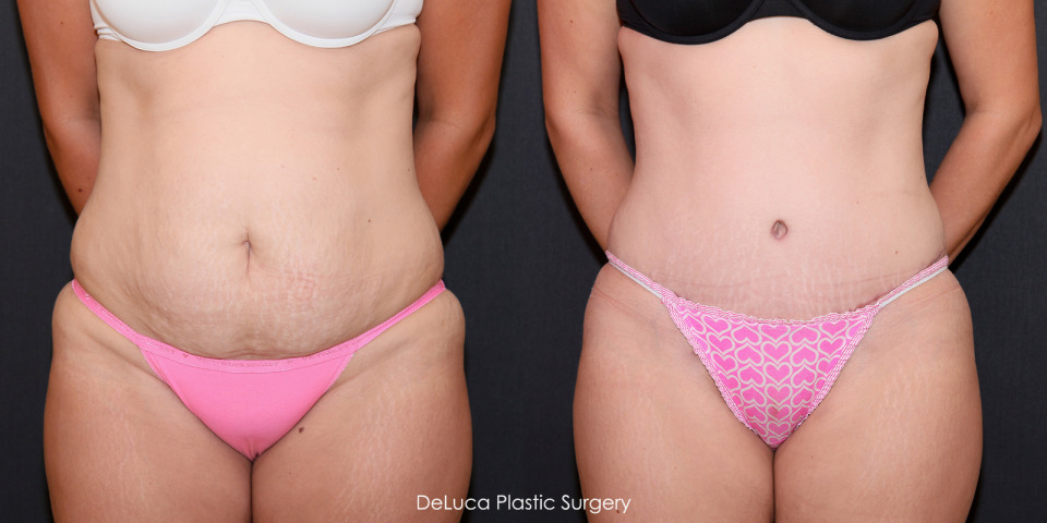 tummy-tuck-plication-before-after-1a.jpg