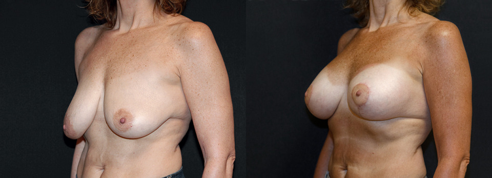vertical-mastopexy-augmentation-before-after-2.jpg