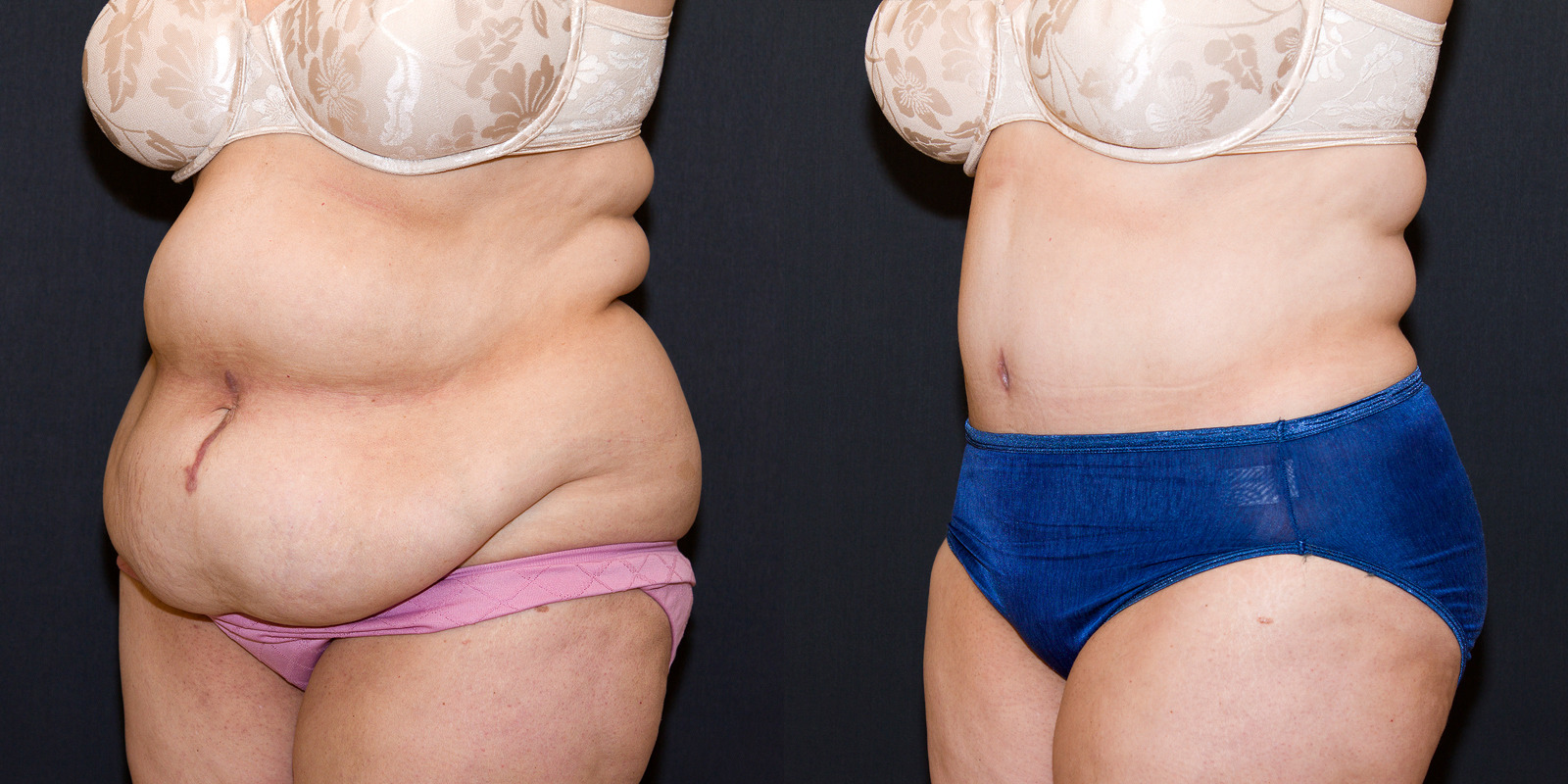 tummy tuck before and after weight loss