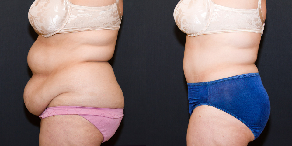 weight-loss-tummy-tuck-before-after-4.jpg